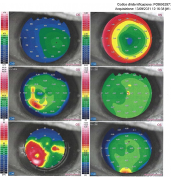 Come si legge la Topografia corneale 3