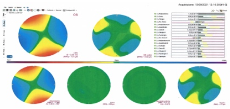 Come si legge la Topografia corneale