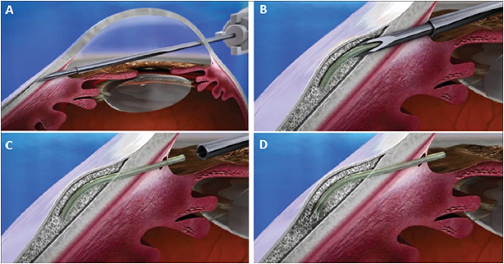 Glaucoma Trattamento chirurgico