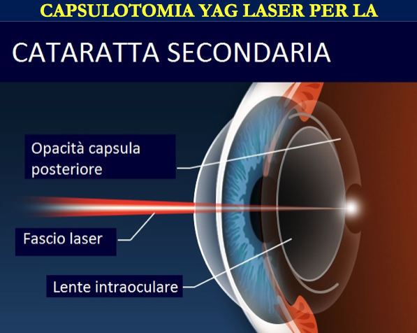 Laser 2RT